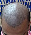Photo for Hair Transplant in India