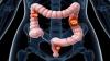 Photo for PharmaPoint: Colorectal Cancer?—?Global Drug Forecast and Market Analysis to 2025