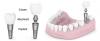Photo for Dental Implant Courses in India