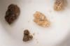 Photo for Kidney Stone Removal Cost in Chennai - Credihealth