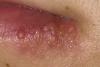 Photo for Apple Cider Vinegar- The Natural Healer