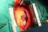 Photo for Bypass Surgery Cost in Chennai