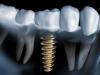 Photo for Global Dental Implants Market to surpass US$ 6269.8 Million by 2024