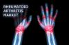 Photo for Rheumatoid Arthritis Treatment Market - Global Industry Insights, Trends, Outlook, and Opportunity Analysis, 2016–2024