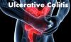 Photo for Ulcerative Colitis Market - Trends, Outlook,  2016–2024