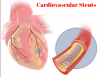 Photo for Cardiovascular Stents Market — Global Industry Insights, Trends, Size, Share, and Opportunity Analysis, 2017–2025