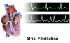 Photo for Atrial Fibrillation Market Global Industry Insights Analysis and 2024 Forecasts