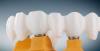Photo for Global Zirconia Dental Material Market by Manufacturers, Countries, Type and Application, Forecast