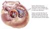 Photo for Heart Valve Replacement Cost in Chennai