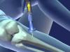Photo for Intraosseous Infusion Devices Market – Global Industry Insights, Trends, Outlook, and Opportunity Analysis, 2017–2025