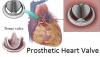 Photo for Prosthetic Heart Valve Market - Global Industry Insights, Trends