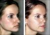 Photo for Rhinoplasty Cost in Chennai - Credihealth