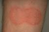 Photo for Mycosis Fungoides-Global API Manufacturers, Marketed and Phase III Drugs Landscape, 2017