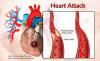 Photo for Myocardial Infarction-Global API Manufacturers, Marketed and Phase III Drugs Landscape, 2017