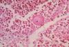 Photo for Mycoses-Global API Manufacturers, Marketed and Phase III Drugs Landscape, 2017
