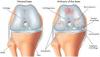 Photo for Osteoarthritis-Global API Manufacturers, Marketed and Phase III Drugs Landscape, 2017