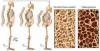 Photo for Osteoporosis-Global API Manufacturers, Marketed and Phase III Drugs Landscape, 2017