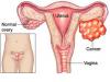 Photo for Ovarian Cancer-Global API Manufacturers, Marketed and Phase III Drugs Landscape, 2017