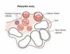 Photo for Ovulatory Dysfunction-Global API Manufacturers, Marketed and Phase III Drugs Landscape, 2017