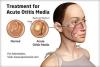 Photo for Otitis Media-Global API Manufacturers, Marketed and Phase III Drugs Landscape, 2017