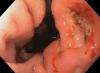 Photo for Peptic Ulcers-Global API Manufacturers, Marketed and Phase III Drugs Landscape, 2017