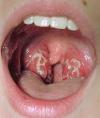Photo for Pharyngitis-Global API Manufacturers, Marketed and Phase III Drugs Landscape, 2017