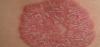Photo for Plaque Psoriasis (Psoriasis Vulgaris)-Global API Manufacturers, Marketed and Phase III Drugs Landscape, 2017