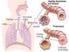 Photo for Pneumonia-Global API Manufacturers, Marketed and Phase III Drugs Landscape, 2017