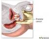 Photo for Prostate Cancer-Global API Manufacturers, Marketed and Phase III Drugs Landscape, 2017