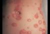 Photo for Psoriasis-Global API Manufacturers, Marketed and Phase III Drugs Landscape, 2017