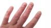 Photo for Psoriatic Arthritis-Global API Manufacturers, Marketed and Phase III Drugs Landscape, 2017