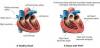 Photo for Pulmonary Arterial Hypertension-Global API Manufacturers, Marketed and Phase III Drugs Landscape, 2017