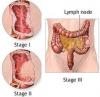Photo for Rectal Cancer-Global API Manufacturers, Marketed and Phase III Drugs Landscape, 2017