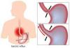 Photo for Reflux Esophagitis (Gastroesophageal Reflux Disease)-Global API Manufacturers, Marketed and Phase III Drugs Landscape, 2017