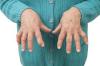Photo for Rheumatoid Arthritis-Global API Manufacturers, Marketed and Phase III Drugs Landscape, 2017