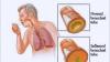 Photo for Respiratory Tract Infections-Global API Manufacturers, Marketed and Phase III Drugs Landscape, 2017
