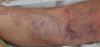 Photo for Skin And Skin Structure Infections (SSSI) Caused By Bacteria-Global API Manufacturers, Marketed and Phase III Drugs Landscape, 2017