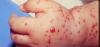 Photo for Staphylococcal Infections-Global API Manufacturers, Marketed and Phase III Drugs Landscape, 2017