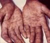 Photo for Syphilis-Global API Manufacturers, Marketed and Phase III Drugs Landscape, 2017