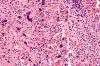 Photo for Systemic Lupus Erythematosus-Global API Manufacturers, Marketed and Phase III Drugs Landscape, 2017