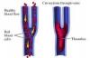 Photo for Thrombosis-Global API Manufacturers, Marketed and Phase III Drugs Landscape, 2017