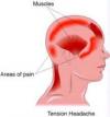 Photo for Tension -Type Headache-Global API Manufacturers, Marketed and Phase III Drugs Landscape, 2017