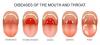 Photo for Tonsillitis-Global API Manufacturers, Marketed and Phase III Drugs Landscape, 2017