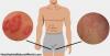 Photo for Tinea Cruris (Jock Itch)-Global API Manufacturers, Marketed and Phase III Drugs Landscape, 2017