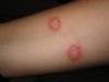 Photo for Tinea Corporis-Global API Manufacturers, Marketed and Phase III Drugs Landscape, 2017