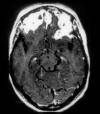 Photo for Tuberculous Meningitis-Global API Manufacturers, Marketed and Phase III Drugs Landscape, 2017