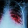 Photo for Tuberculosis-Global API Manufacturers, Marketed and Phase III Drugs Landscape, 2017