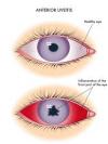 Photo for Uveitis-Global API Manufacturers, Marketed and Phase III Drugs Landscape, 2017