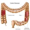 Photo for Ulcerative Colitis-Global API Manufacturers, Marketed and Phase III Drugs Landscape, 2017