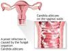 Photo for Vulvovaginal Candidiasis-Global API Manufacturers, Marketed and Phase III Drugs Landscape, 2017